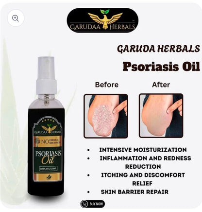 Psoriasis Herbal Relief Oil